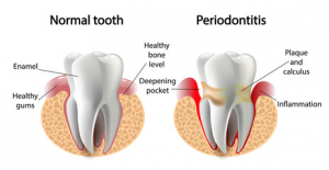 a comparison of a normal, healthy tooth versus a tooth affected by periodontal disease