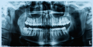 a dental x-ray of a complete set of teeth